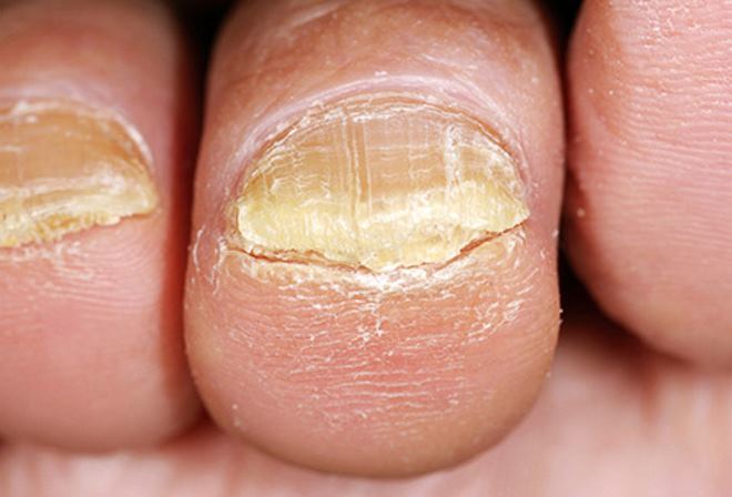 Как избавиться от грибка на ногтях